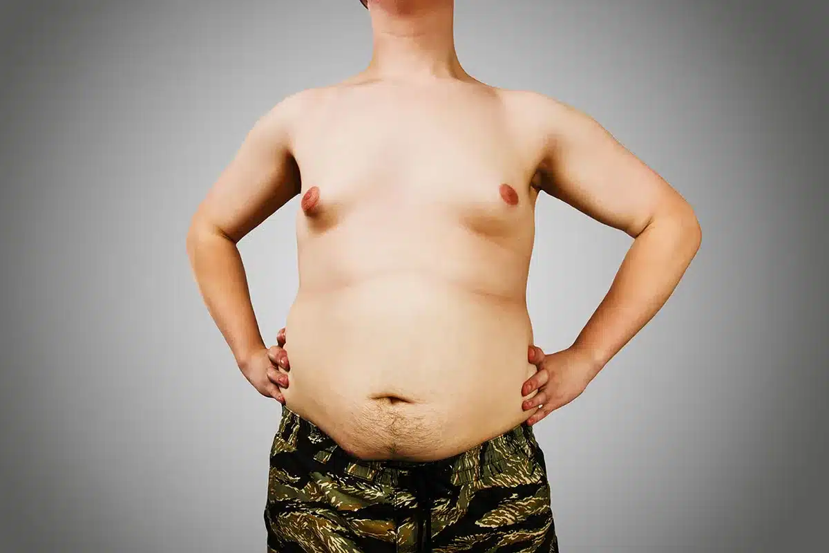 Torso of a person with significant abdominal fat.