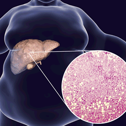 NASH Cause of Liver Cancer - Featured Image