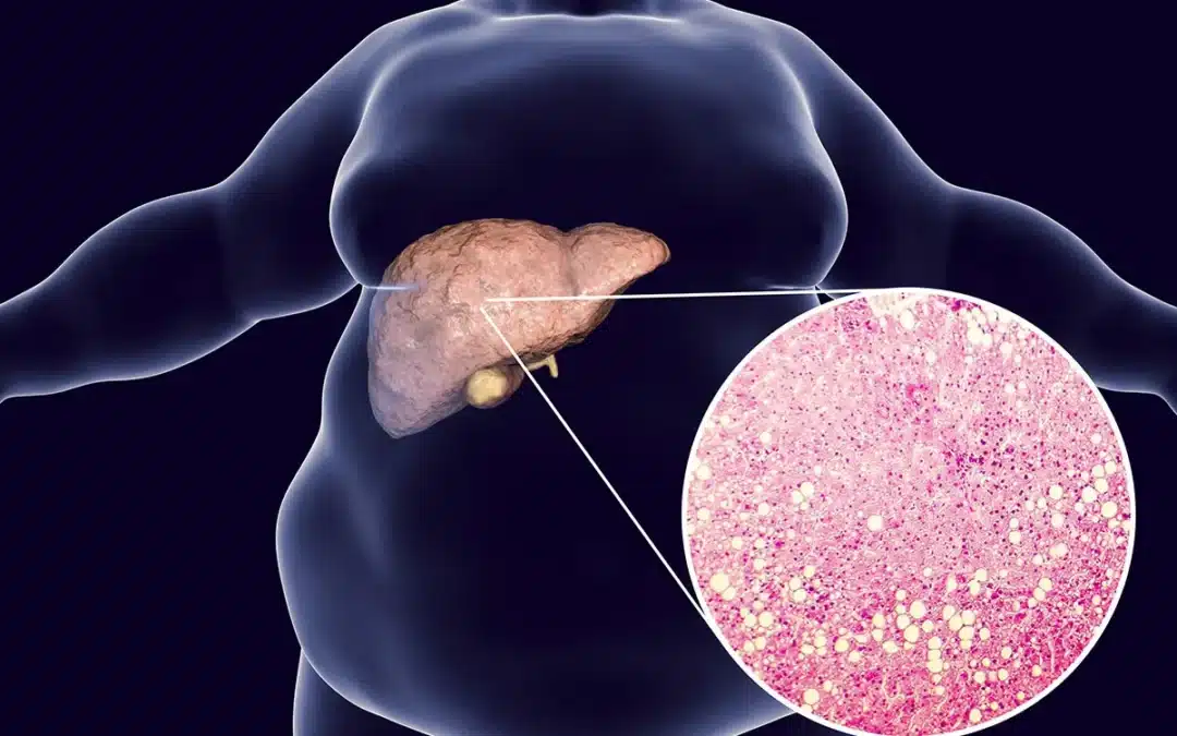 NASH Rapidly Overtaking Hepatitis C as a Cause of Liver Cancer