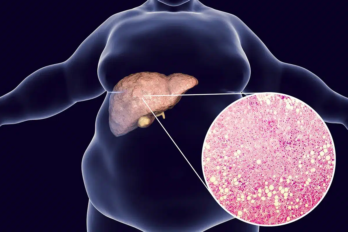 Fatty liver disease illustration.